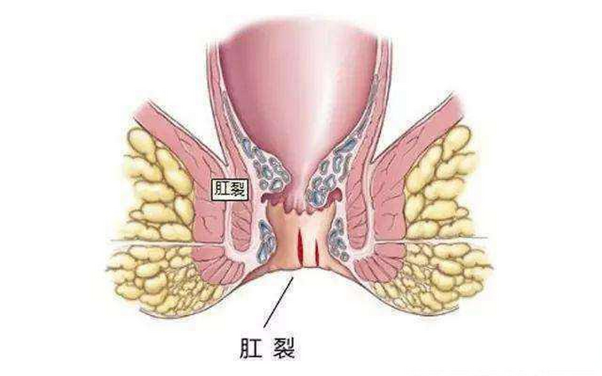 别以为就是痔疮在作怪,先要做自身反省,看看有没有