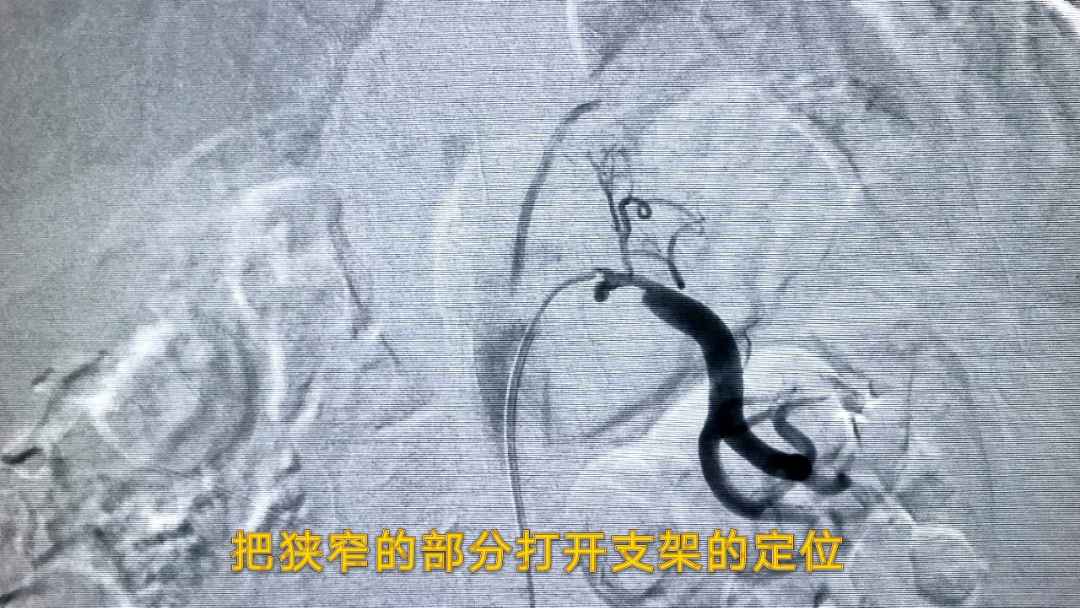 38岁病友,长期高血压服药控制效果不佳,头晕头痛入院,检查为肾动脉狭窄,手术两小时后,解决