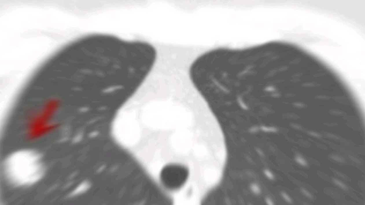 这应该是个良性的病灶,为什么刘医生仍然建议手术干预?因为该结节是直径达2厘米的实性病灶,又