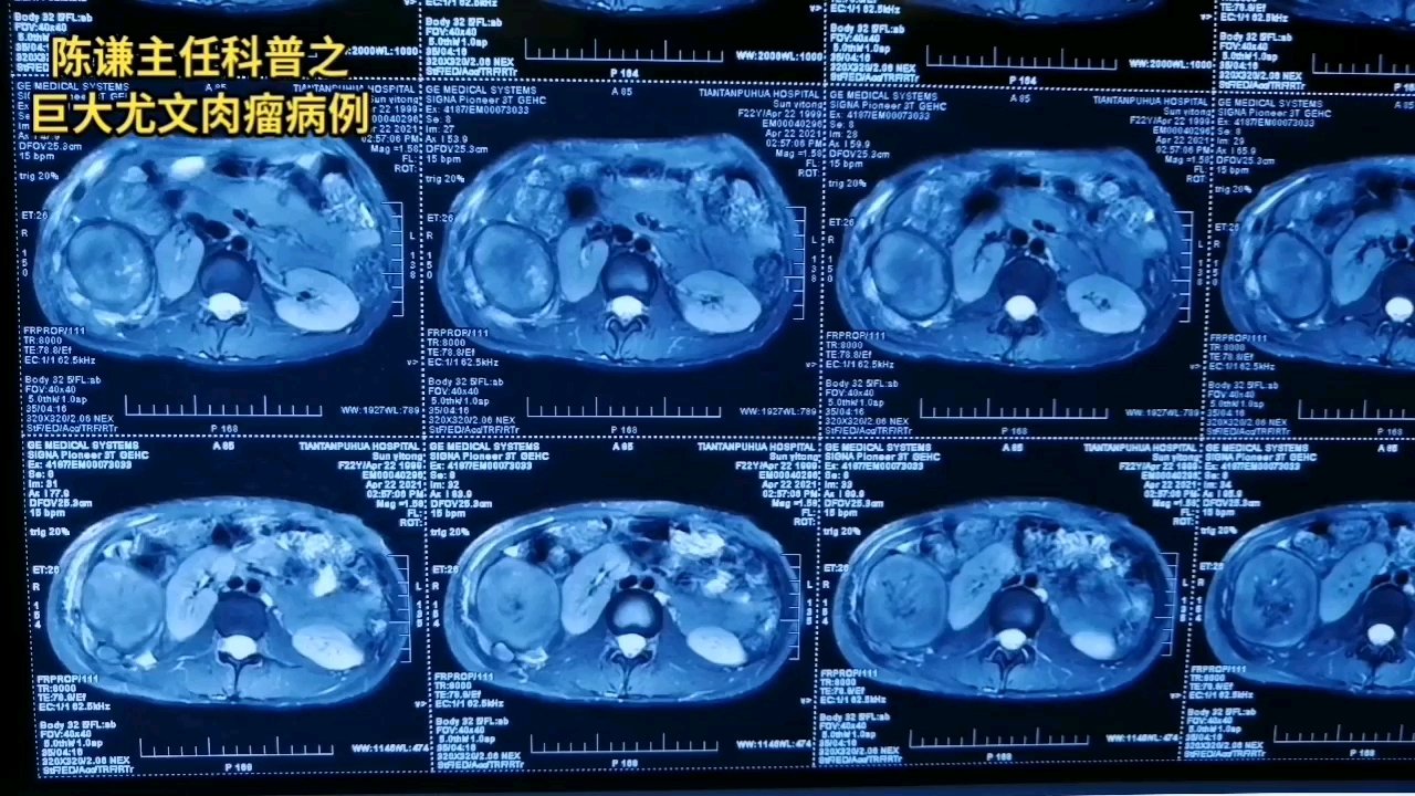 这是一个22岁的大学生,一年前发现右侧胸壁包块,没有及时治疗,之后包块增大伴疼痛明显,最终