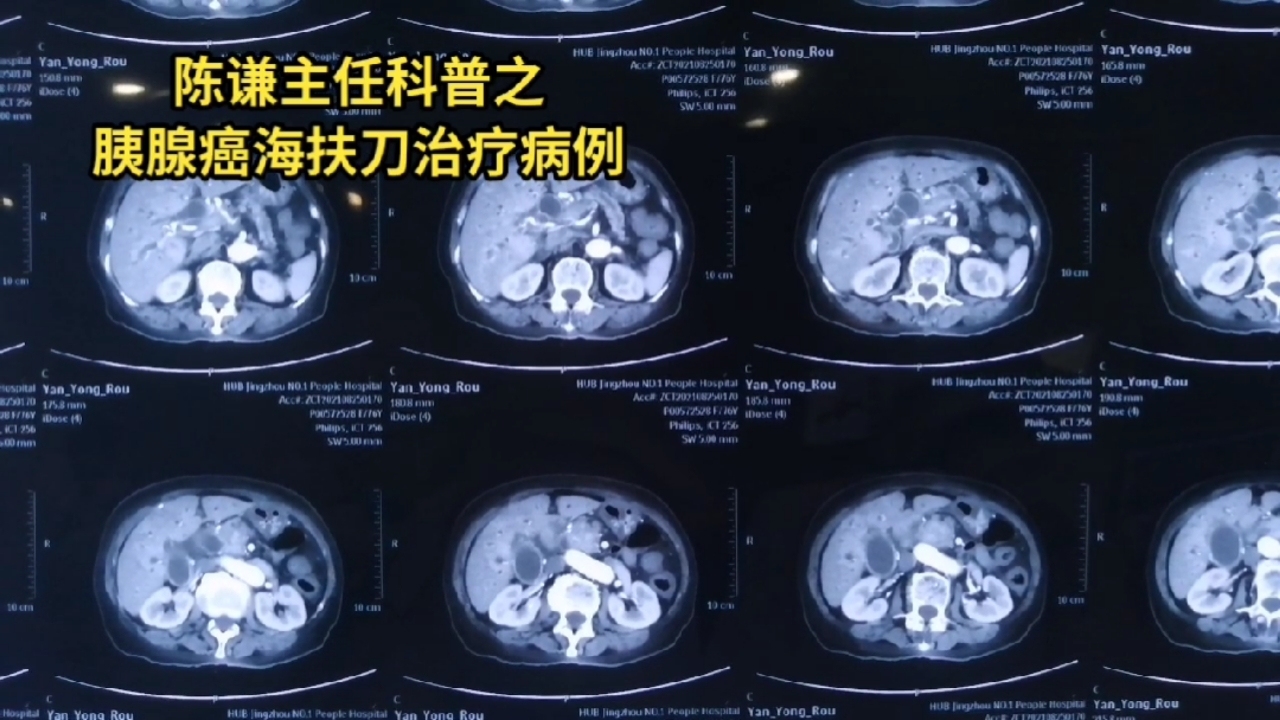 76岁胰腺癌患者海扶刀治疗病例,这是一个76岁胰腺癌患者,病人来自湖北荆州。病人一月前因黄