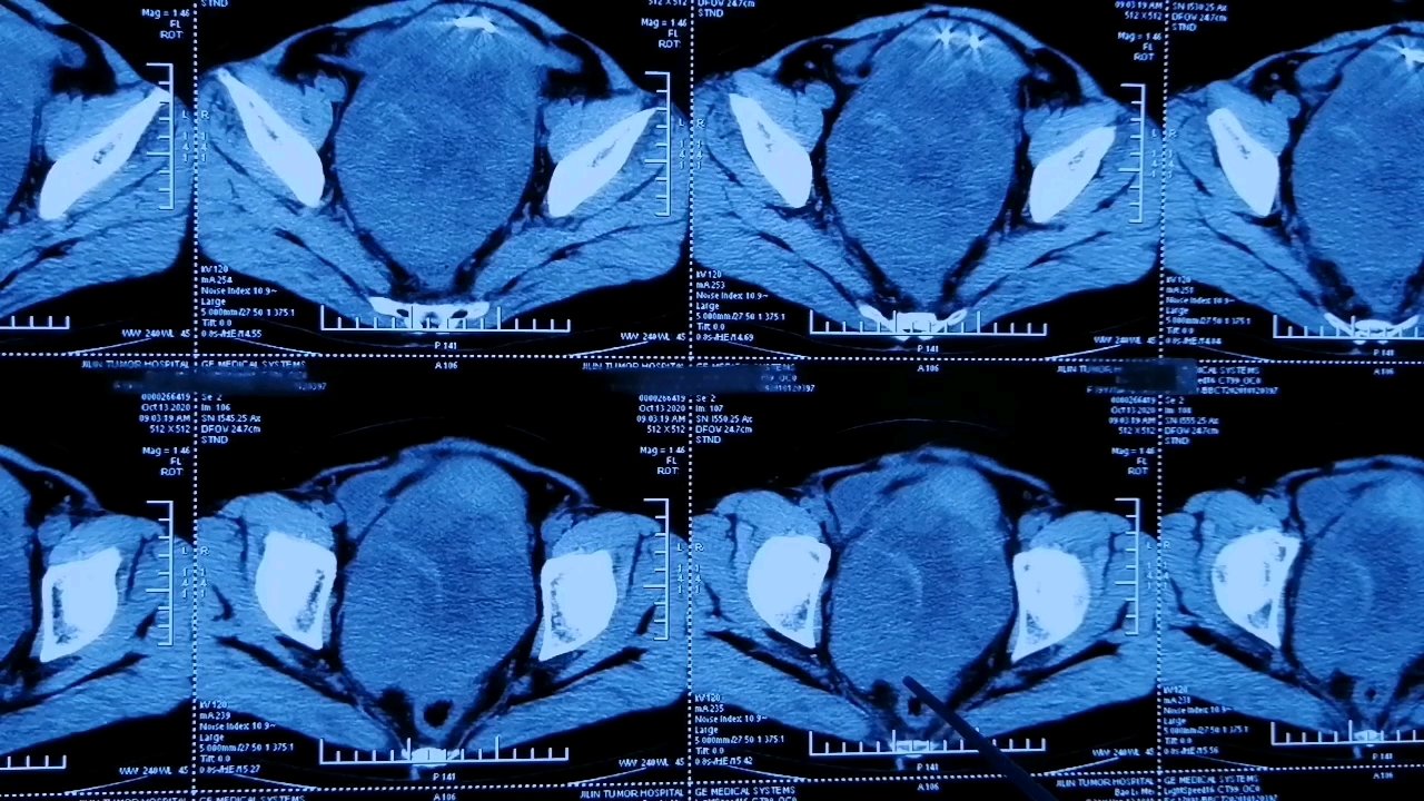  这是一个滑膜肉瘤多次手术后复发,放化疗后盆腔转移,肿瘤压迫膀胱肠道。从CT上可见肿瘤巨大