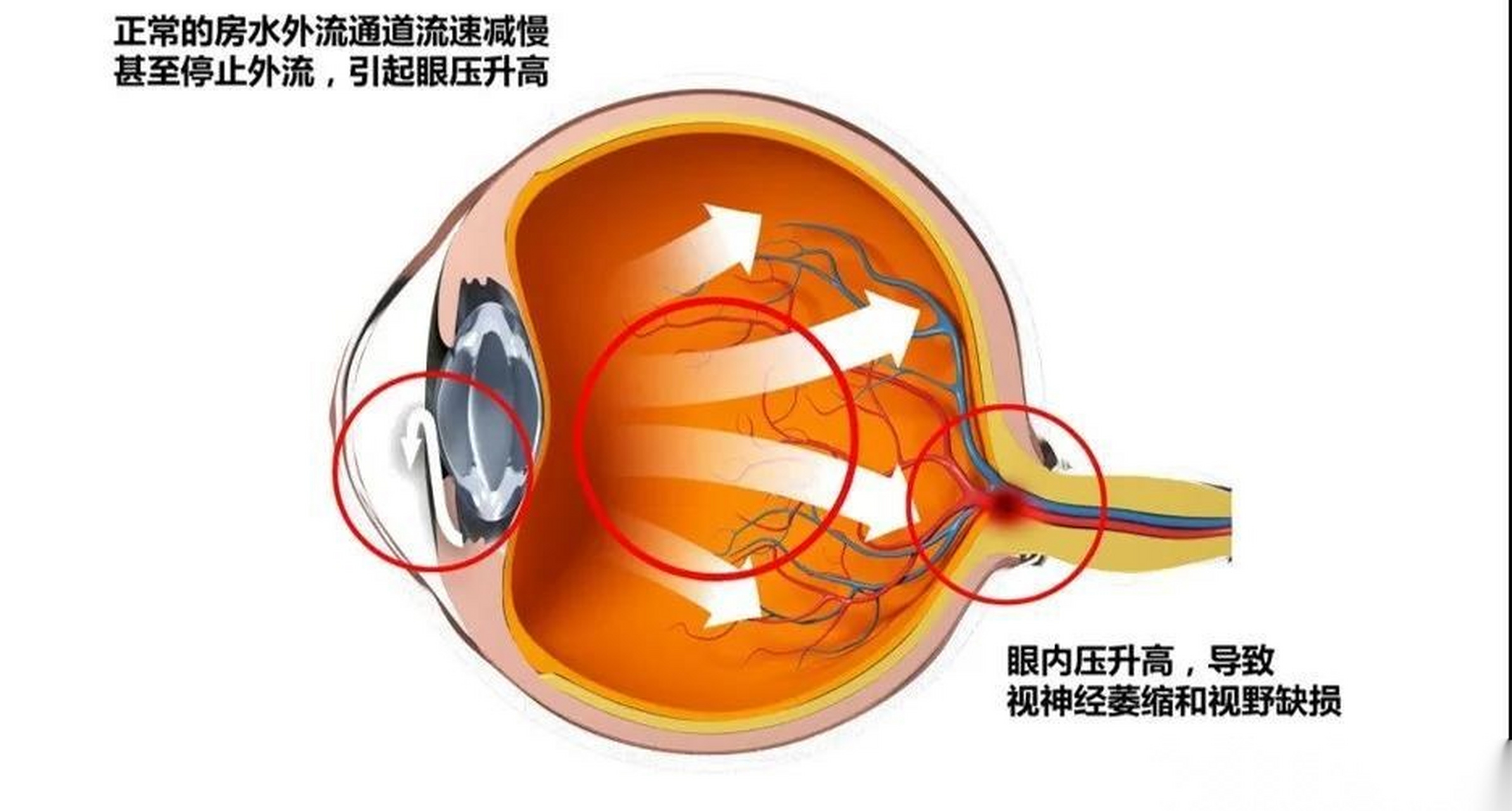 青光眼#特別注意青光眼預防人群:1,有青光眼家族史或年齡超過40歲