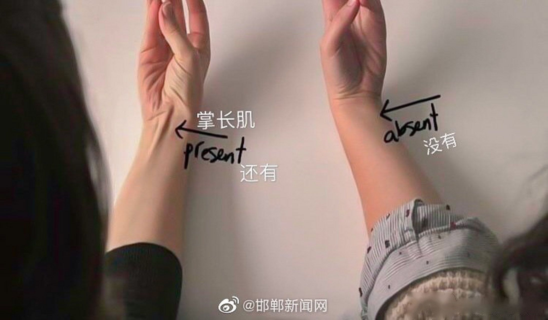 有的人没有掌长肌  掌长肌缺失(palmaris longus)这个情况并不算太