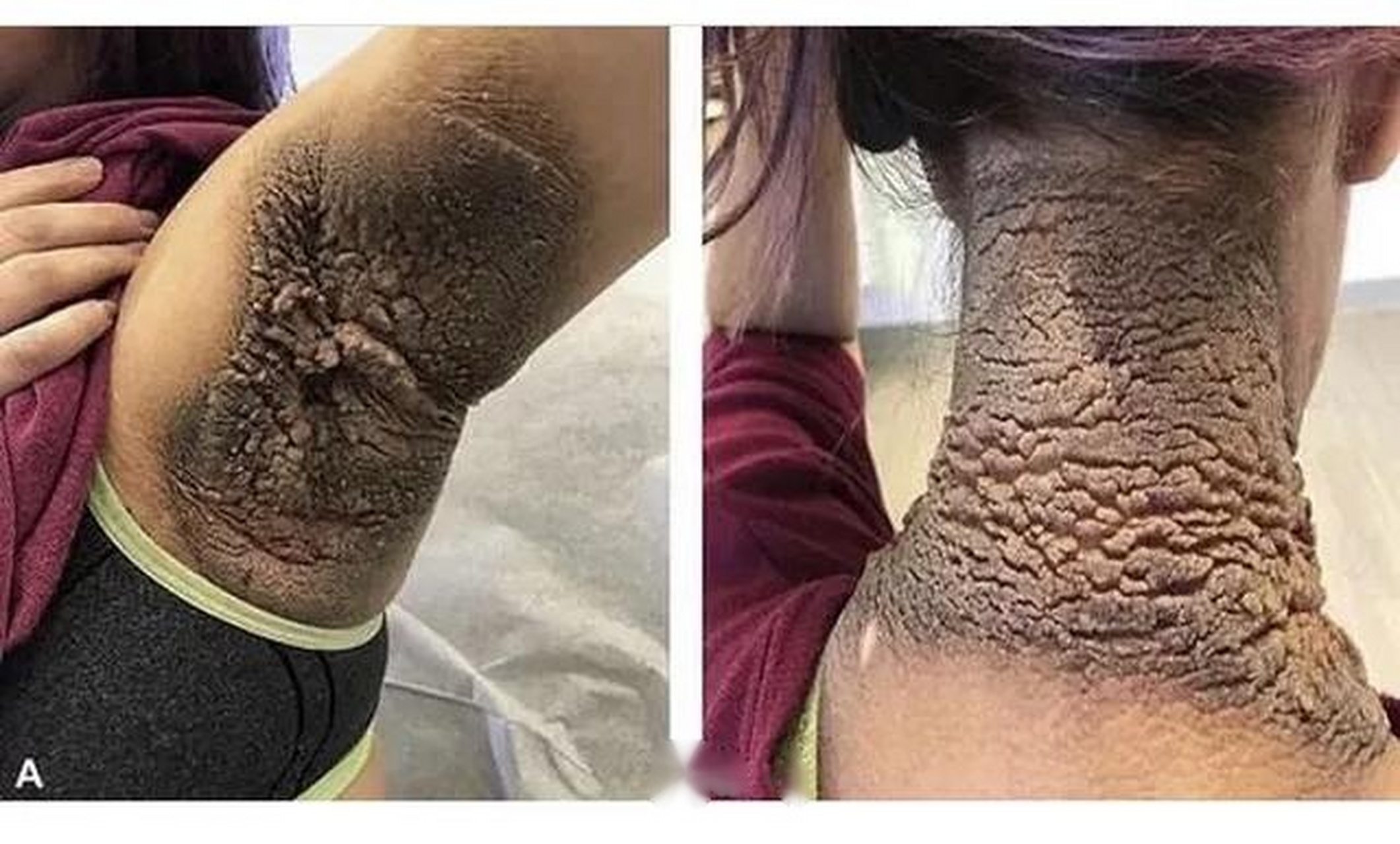 黑棘皮病,最常见的原因是肥胖和糖尿病.