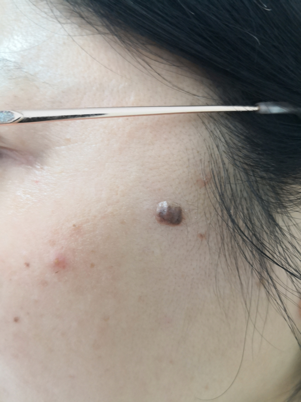 面部色素痣症状#美容##解决皮肤问题专注皮肤美容##皮肤# 比较大的