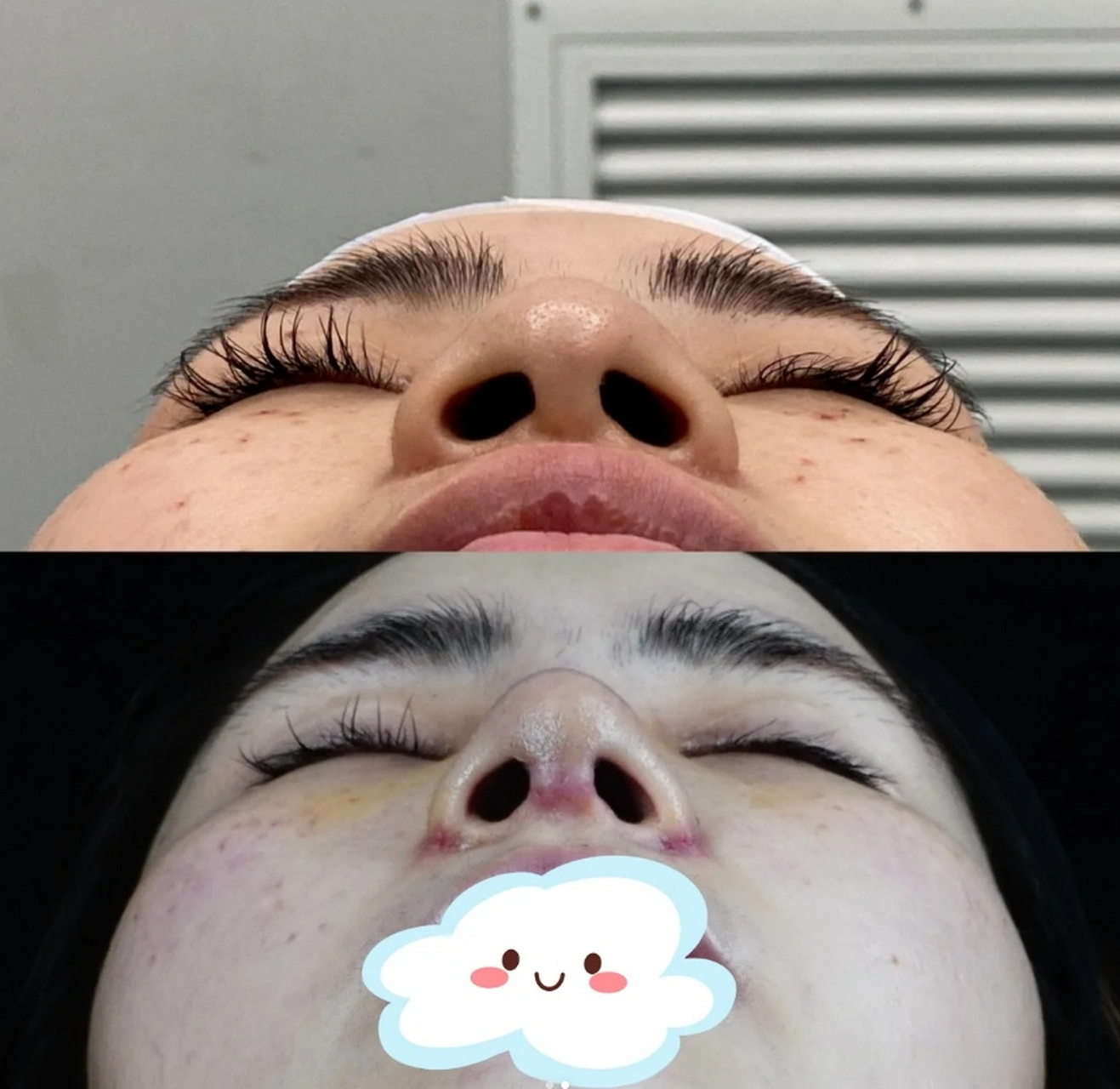 鼻基底小鼻术效果即时效果  鼻翼鼻头缩小 鼻小柱  有变化了吧,嘻嘻