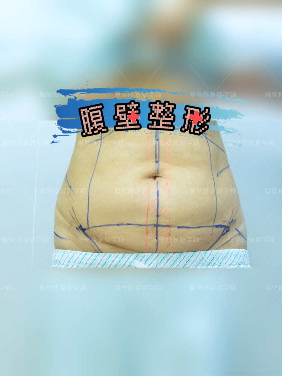 腹壁整形案例分析:分了两层来缝合腹直肌 这个求美者,她主要问题是:术