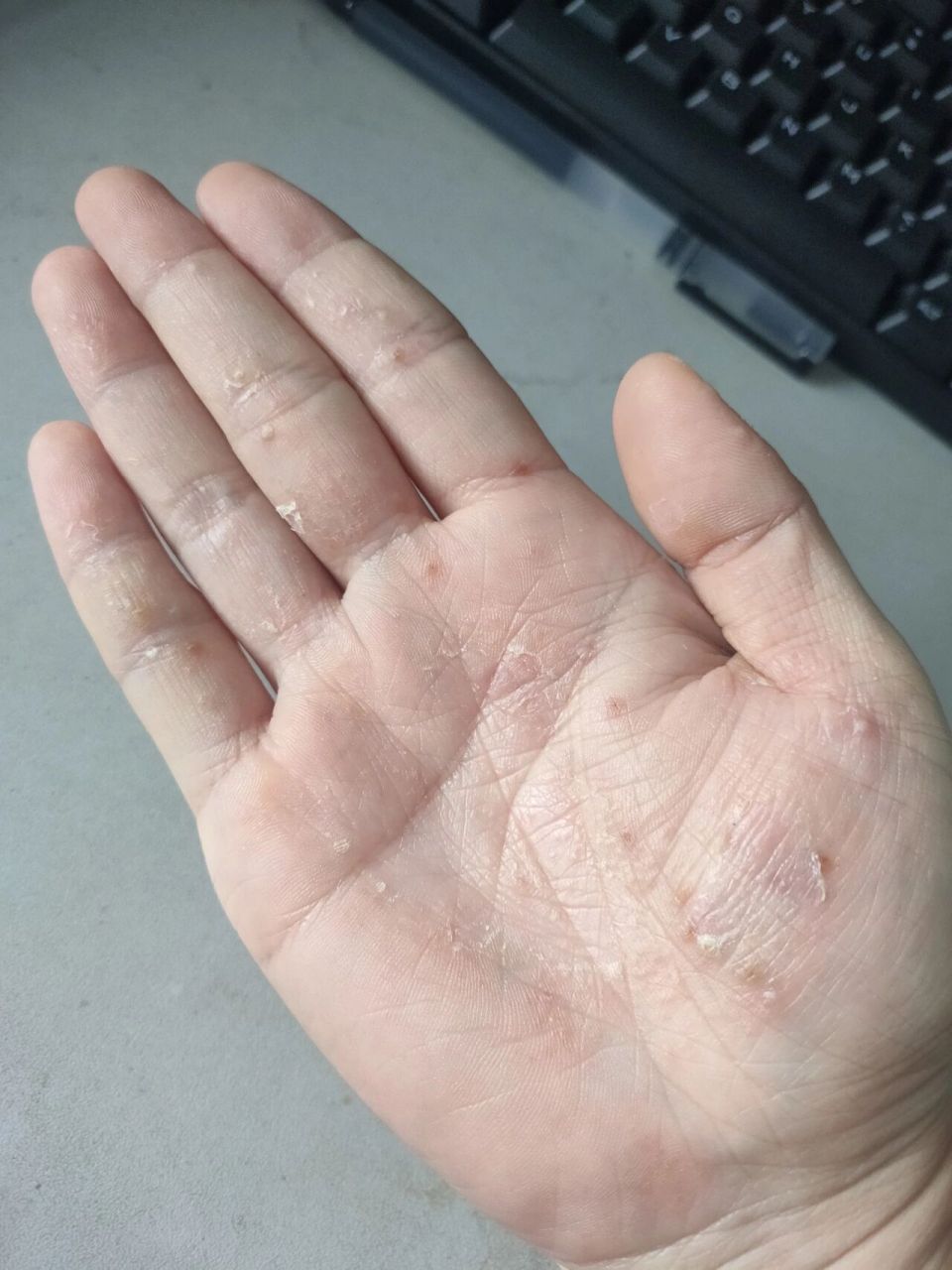 且写笔记超过半个月的我,发现已经有一些病友用盐水泡掌跖脓疱病以后