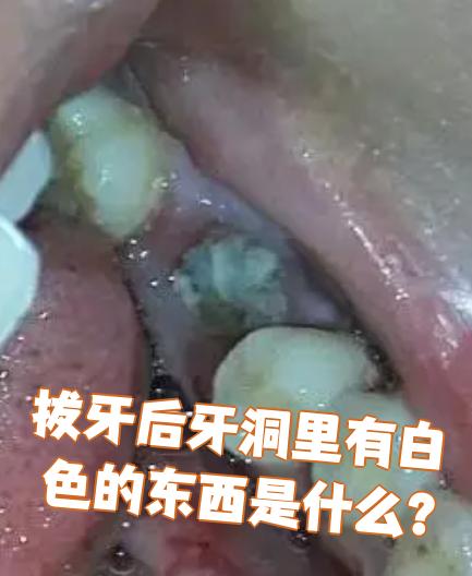 拔牙后牙洞里有白色的东西是什么?