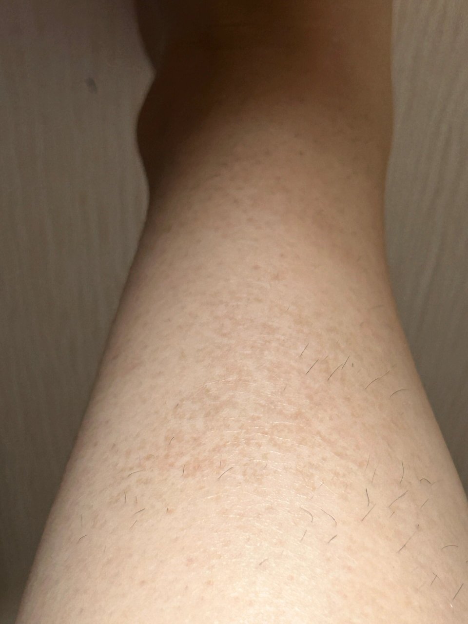 腿上这种斑叫啥 怎么去掉? 小腿上几年前长的
