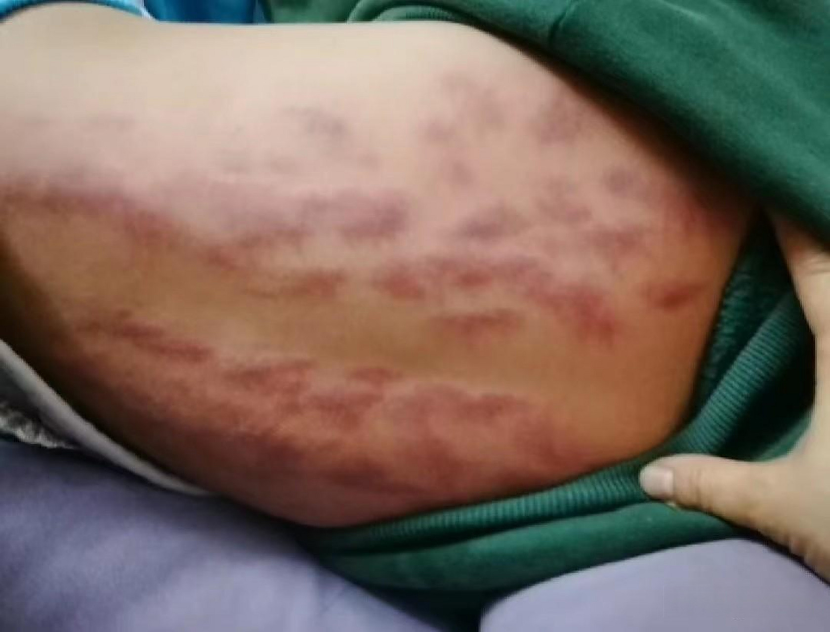 这件事情超出了我的认知,请问把孩子的背揪得通红,可以治疗发烧吗?