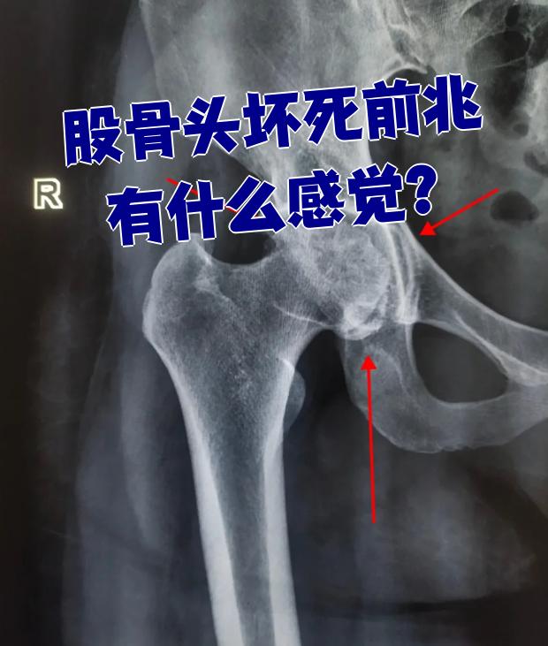 股骨头坏死早期最明显的症状就是腹股沟区或髋关节周围的酸胀感