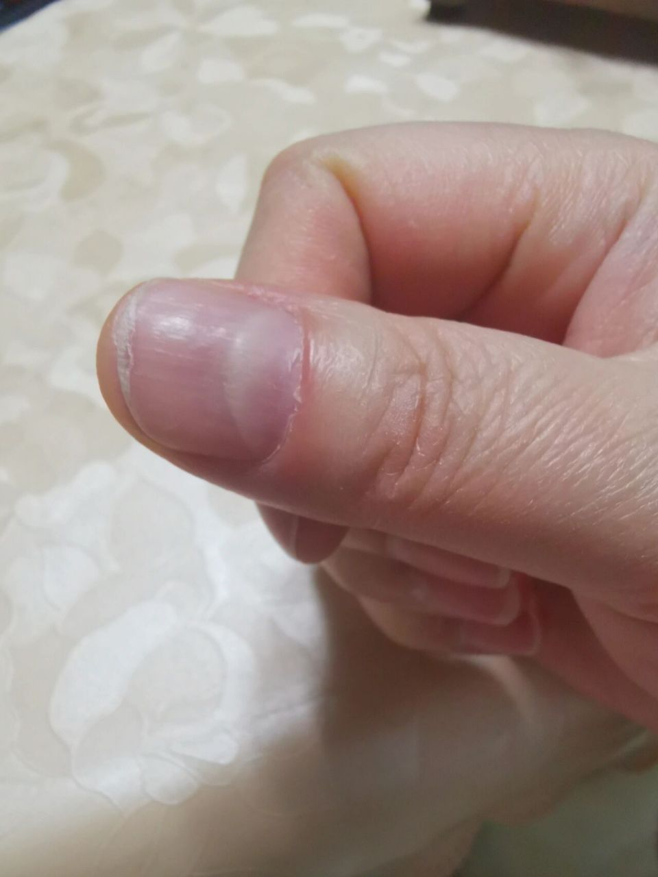 指甲起层是什么原因?