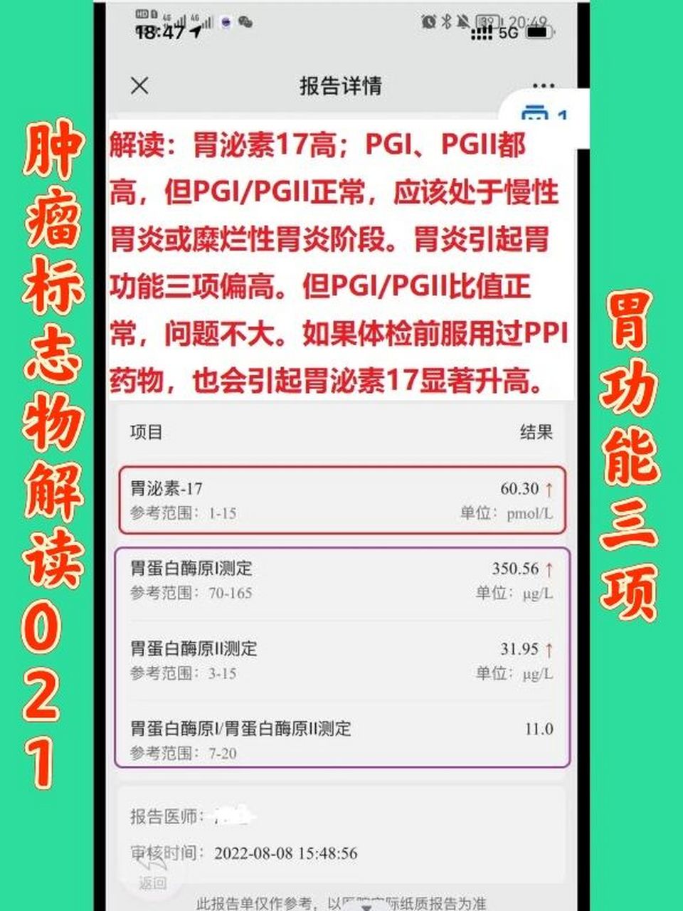 体检中的肿瘤标志物解读021 解读:胃泌素17高;pgi,pgii都高,但pgi