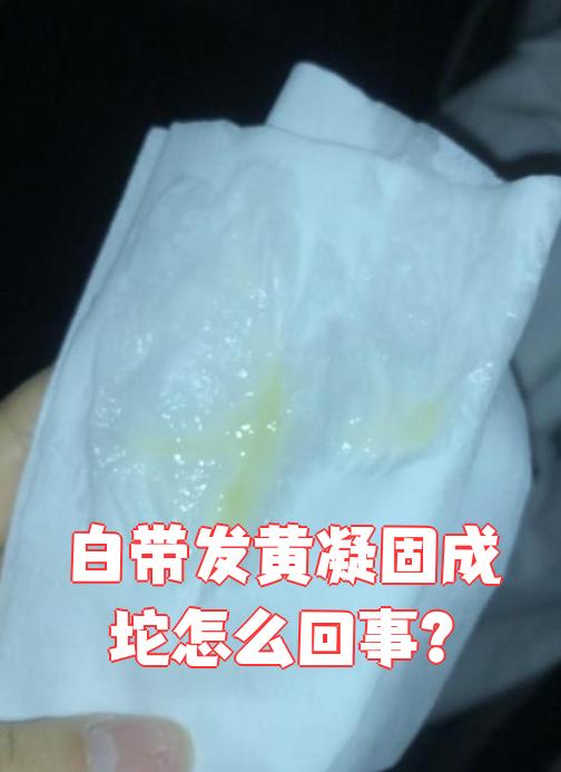 白带发黄凝固成坨常见原因有三个:排卵期,阴道炎或妊娠期