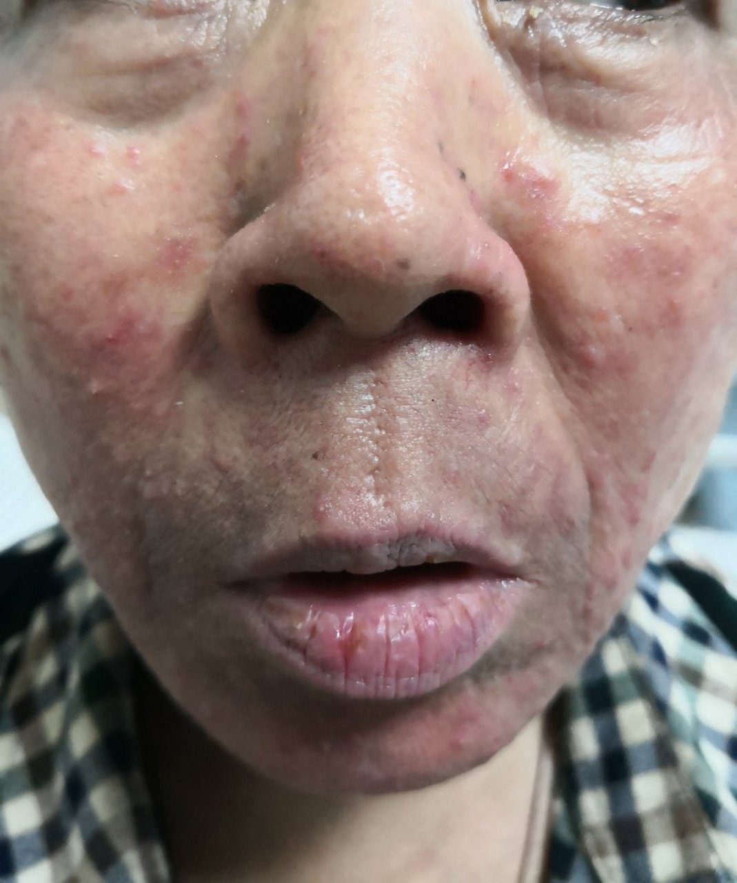 面部红斑丘疹结节症状.活检排查考虑玫瑰痤疮.