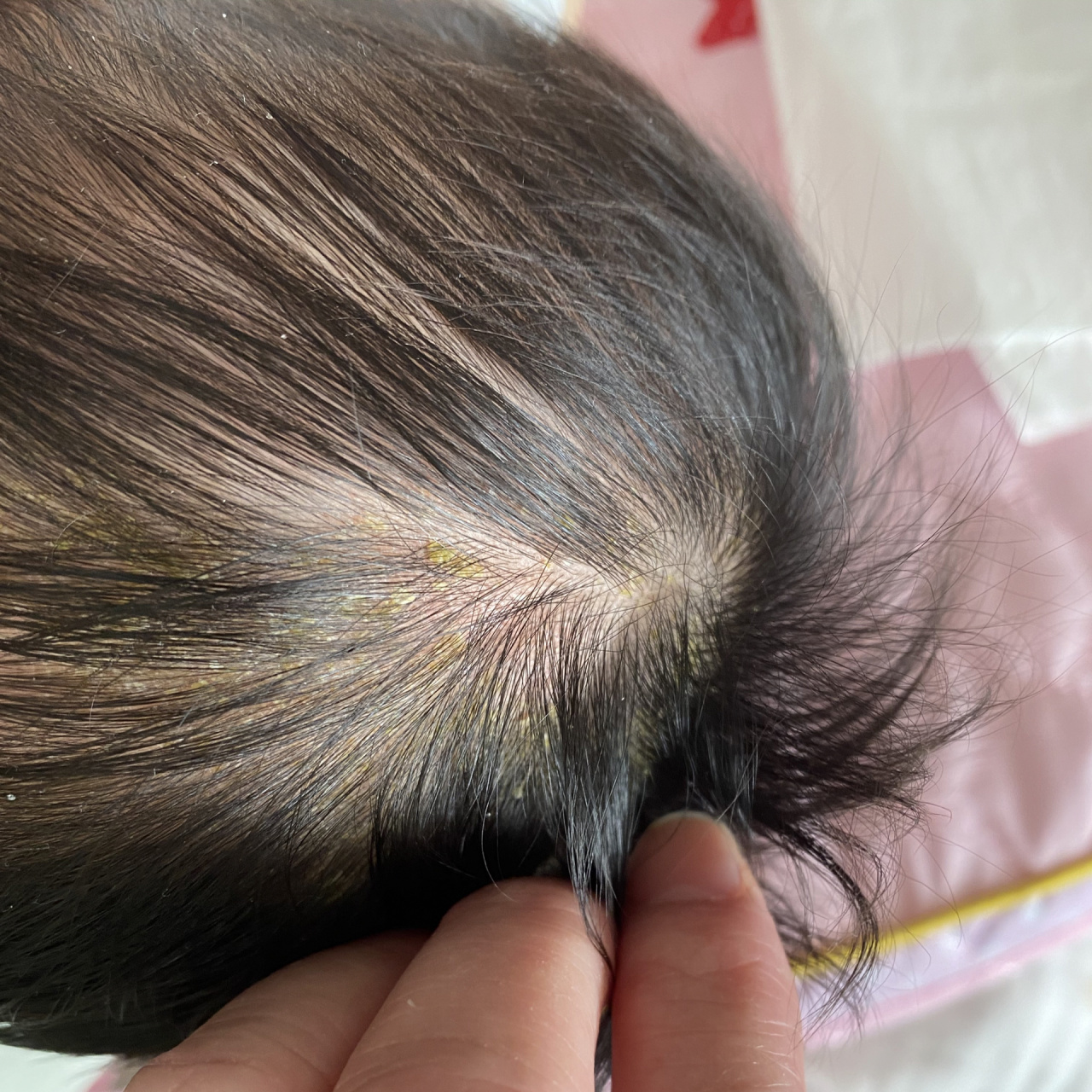 宝妈小记  | 宝宝头皮上乳痂的处理方式 女鹅现在快两个半月,在她一个