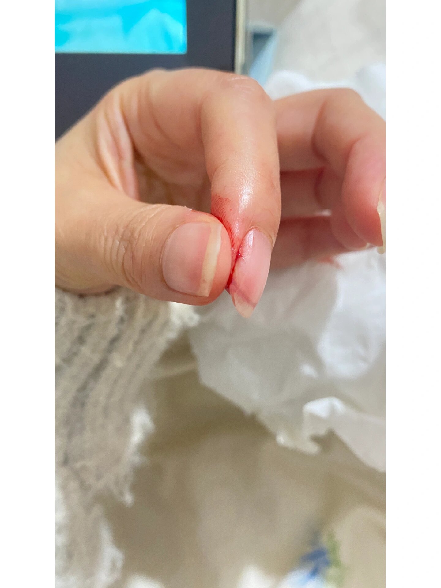 菜刀切到手指了这种程度需要打破伤风吗?