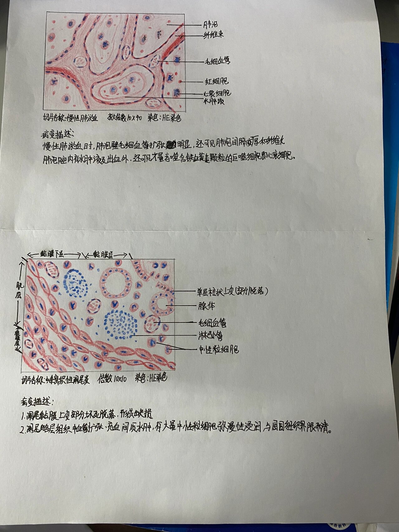 肾凝固性坏死手绘图图片