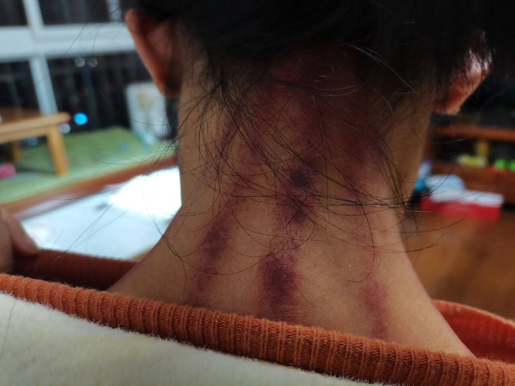 头重重的,脖子胀,让老公揪痧试试,结果不一会儿出痧了,还摸到一个泡