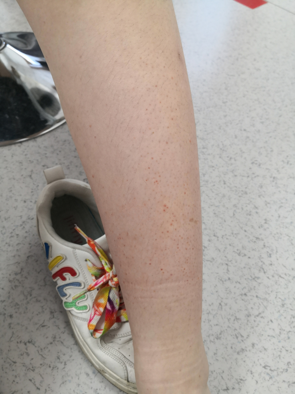 过敏性紫癜症状.#解决皮肤问题专注皮肤美容##过敏性紫癜