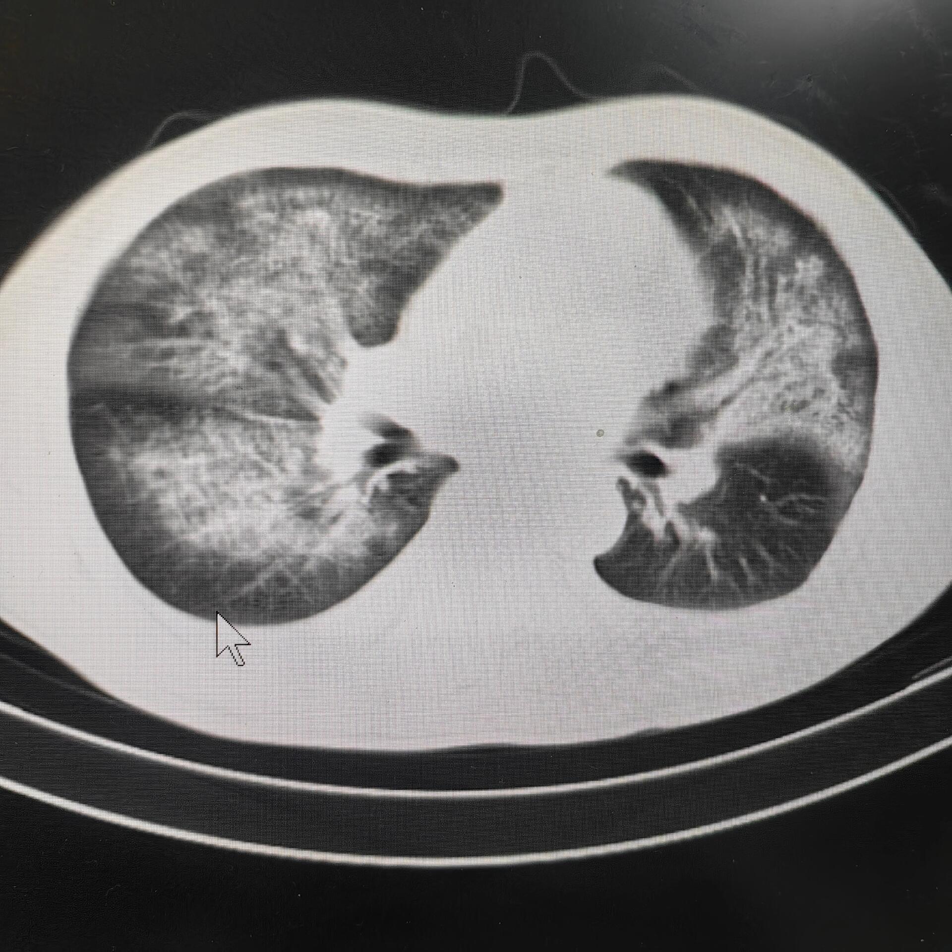 胸部影像 1 肺泡性肺水肿