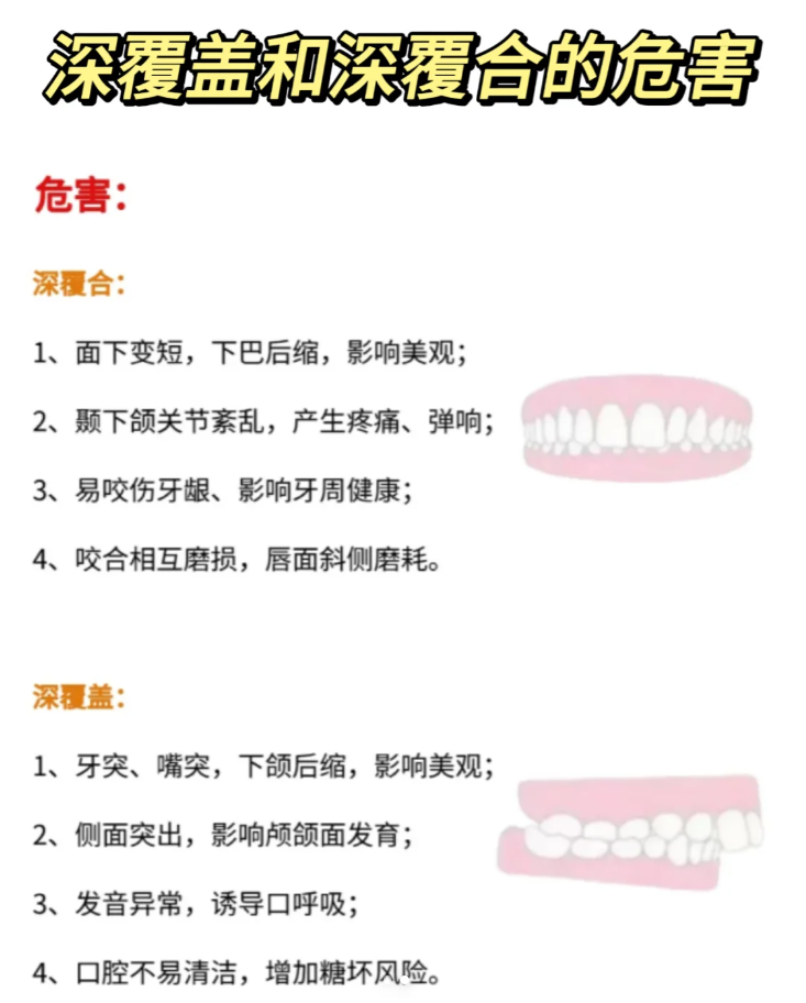 区别深覆合上下关系垂直距离过大:轻度:上前牙覆盖下前牙1/3以上或1/2