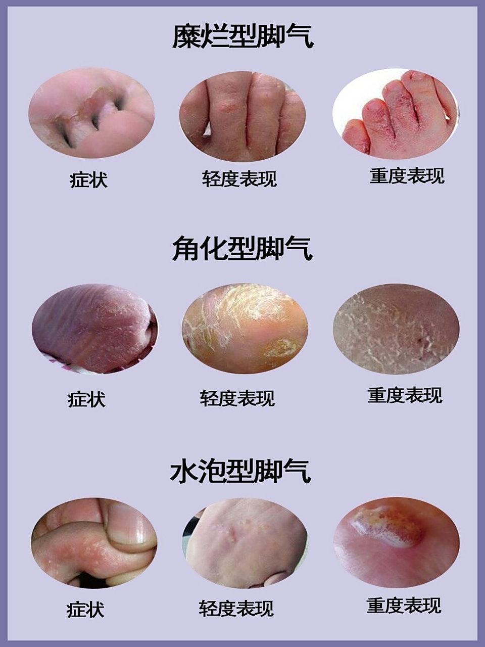 脚气解析大全,轻轻松松搞定脚气问题 脚气的症状为脚趾间会出现水疱
