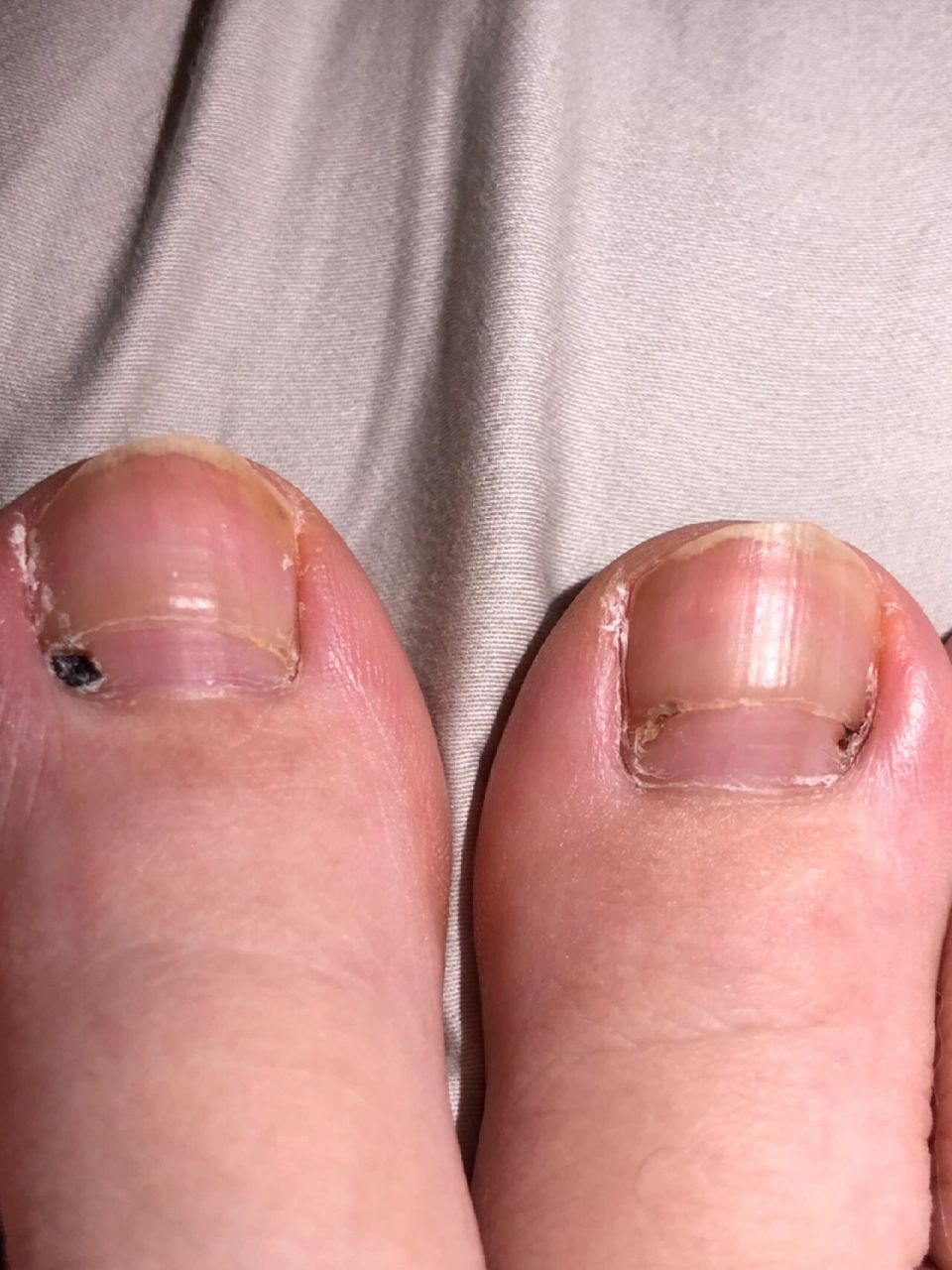 脚趾发黑 生完娃1个月的时候,大脚趾一直微微痛,以为是生完之后缺钙