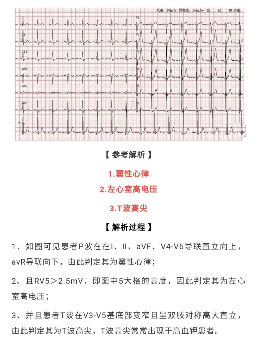 心电图电压图片