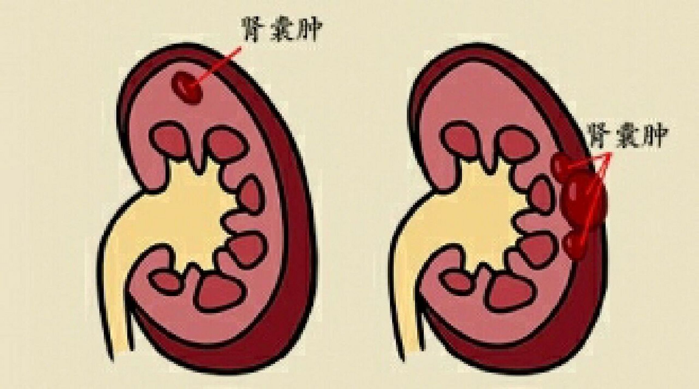 那么肾囊肿是怎么回事?需要治疗吗,今天作