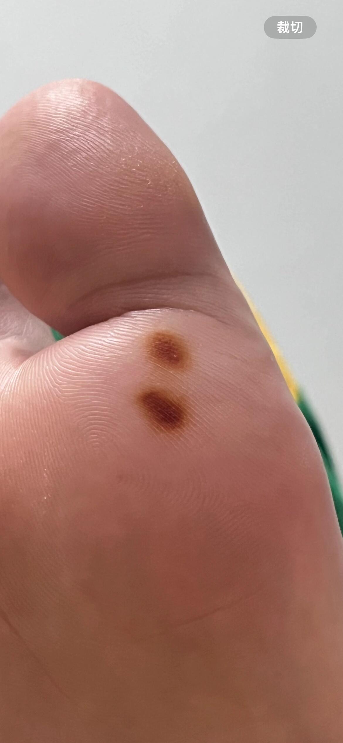 下班回家发现脚底有2个点 怎么回事啊!