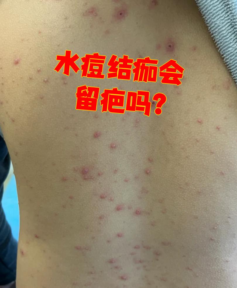 水痘结痂后会不会留疤要看具体情况