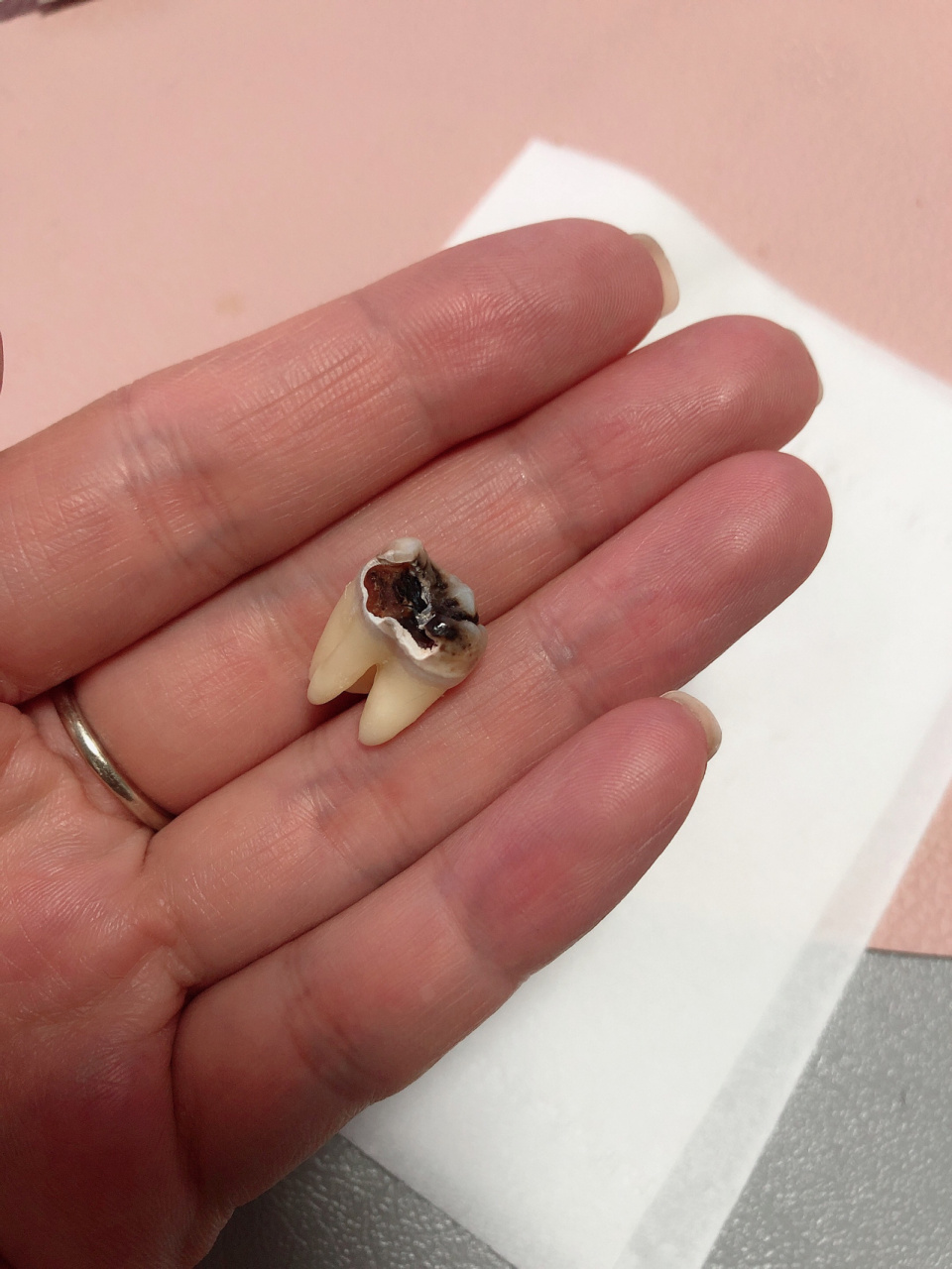 智齿烂了 终于拔下来了 也不知道什么时候长的智齿 更不知道它什么