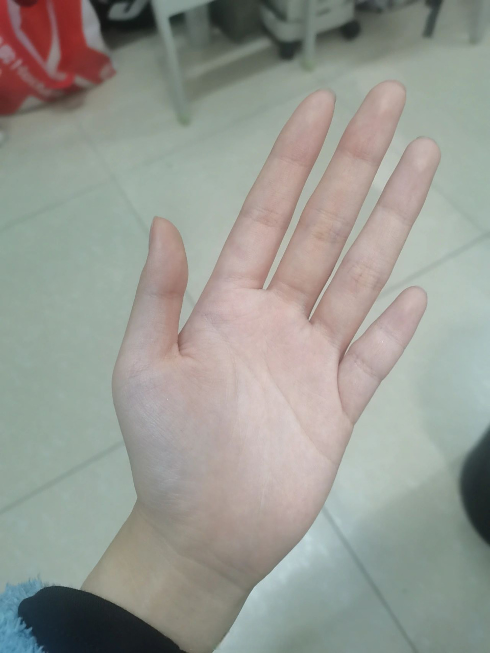 短指症#这才是短指症!小拇指真的很短很短很短