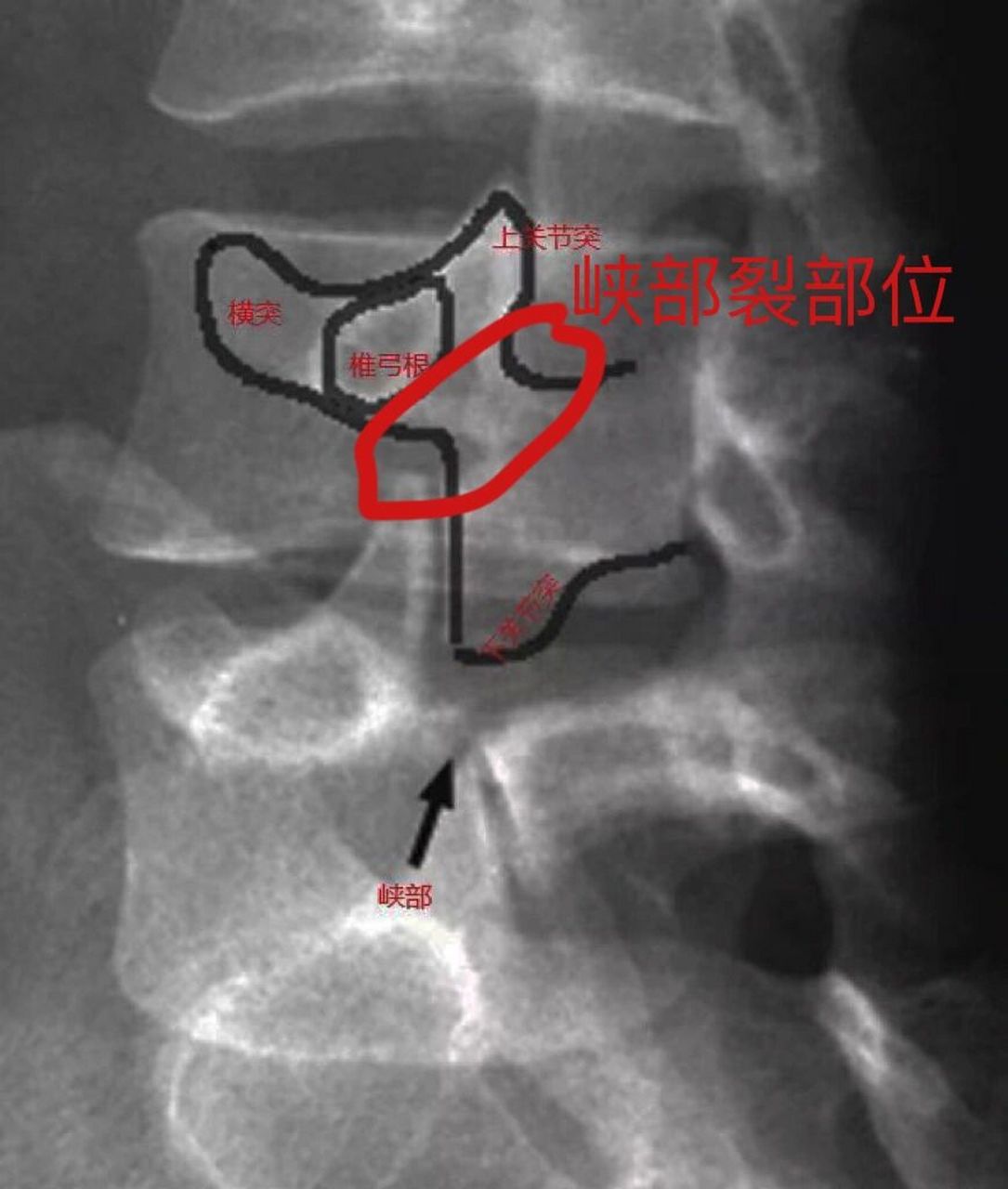 先天性峡部裂图片