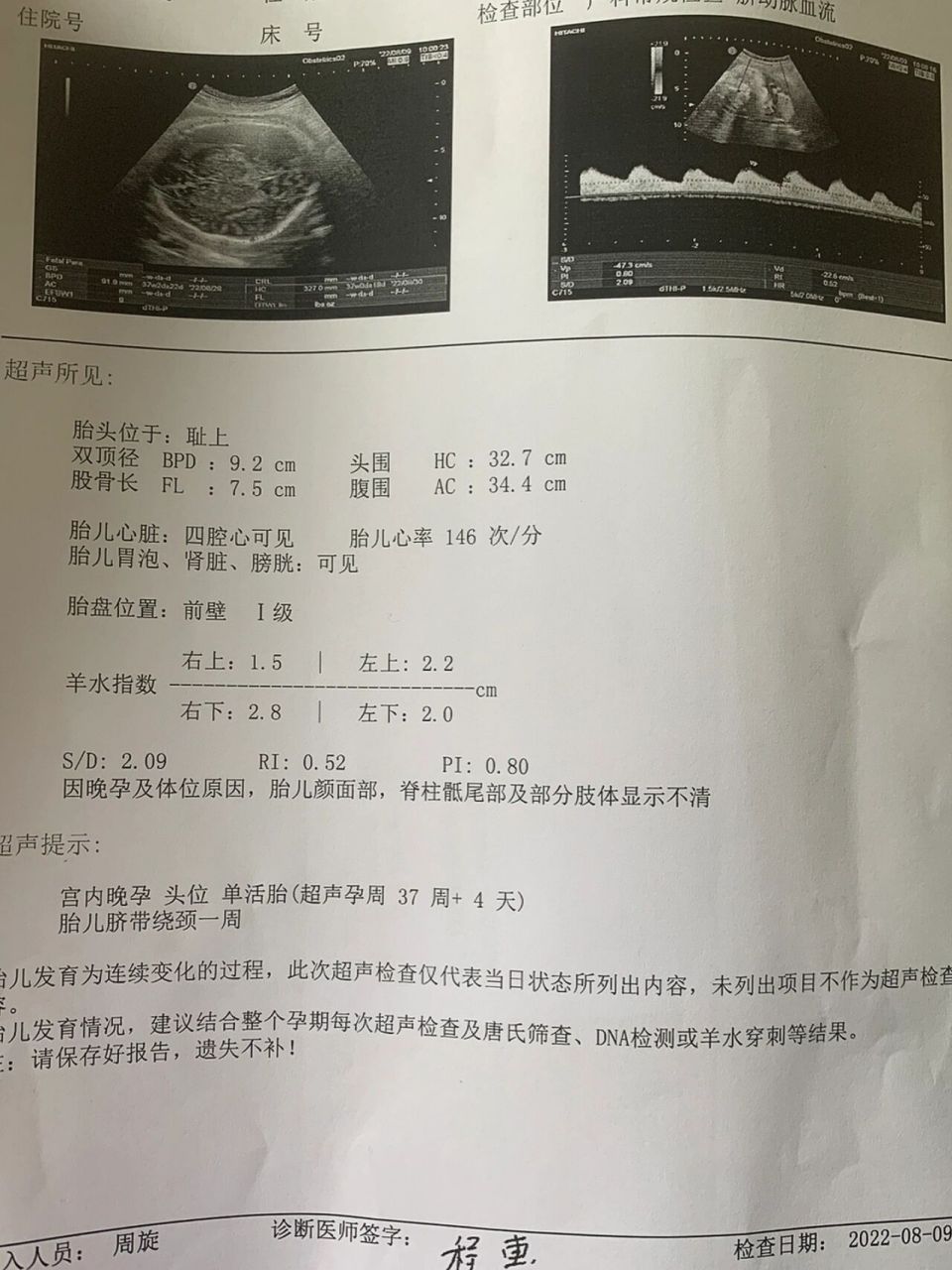 38771周 胎盘成熟度才1级,还有多久能生啊? 预产期8.
