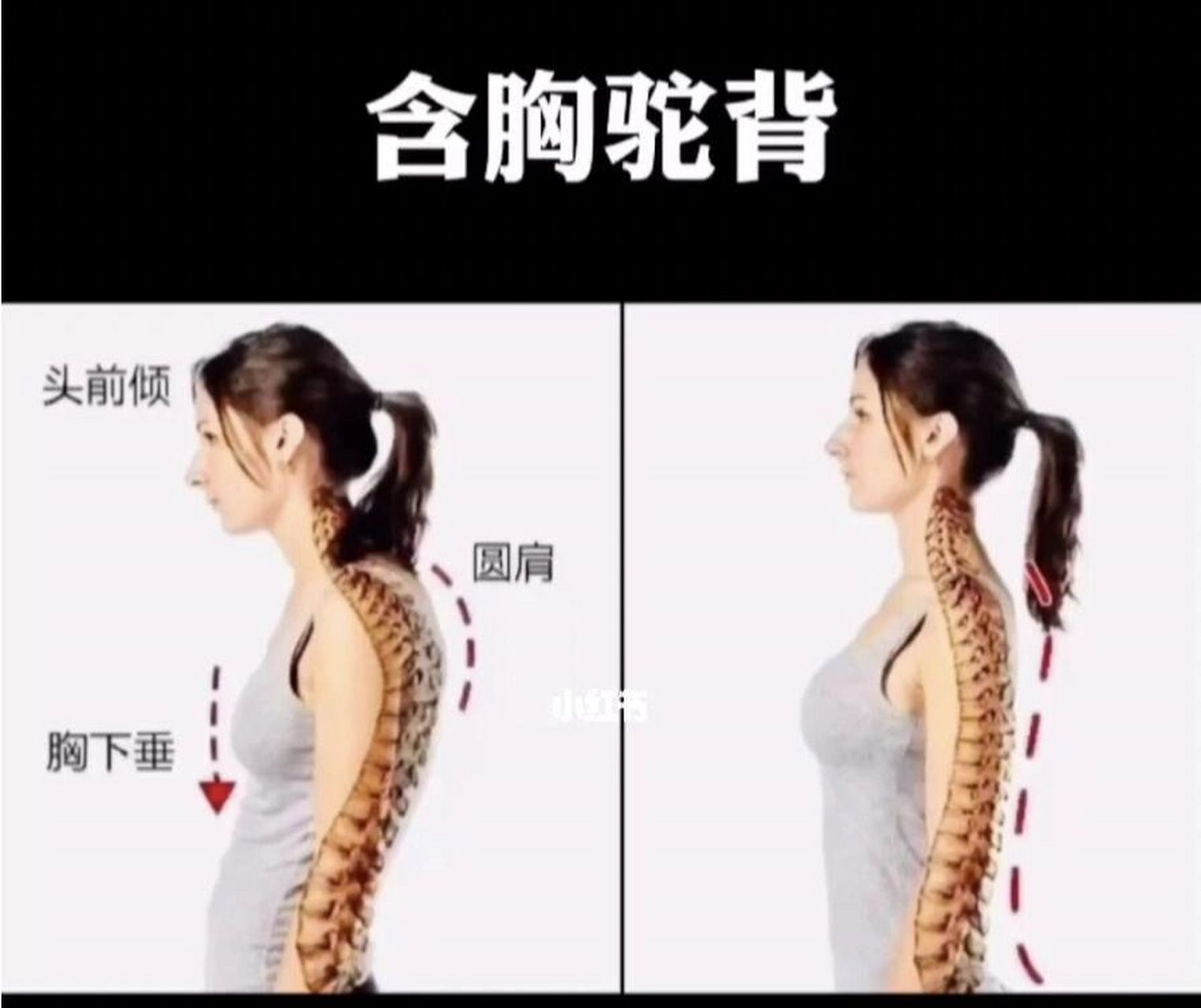 含胸驼背危害 含胸驼背的危害,具体如下: 1,影响美观:对于年轻人来说