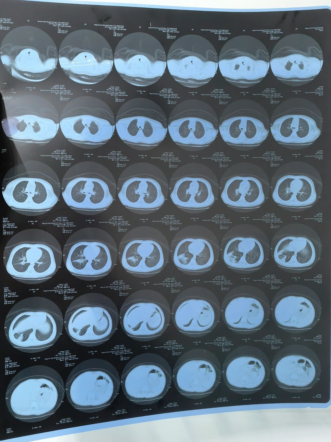 大叶性肺炎dr图片图片