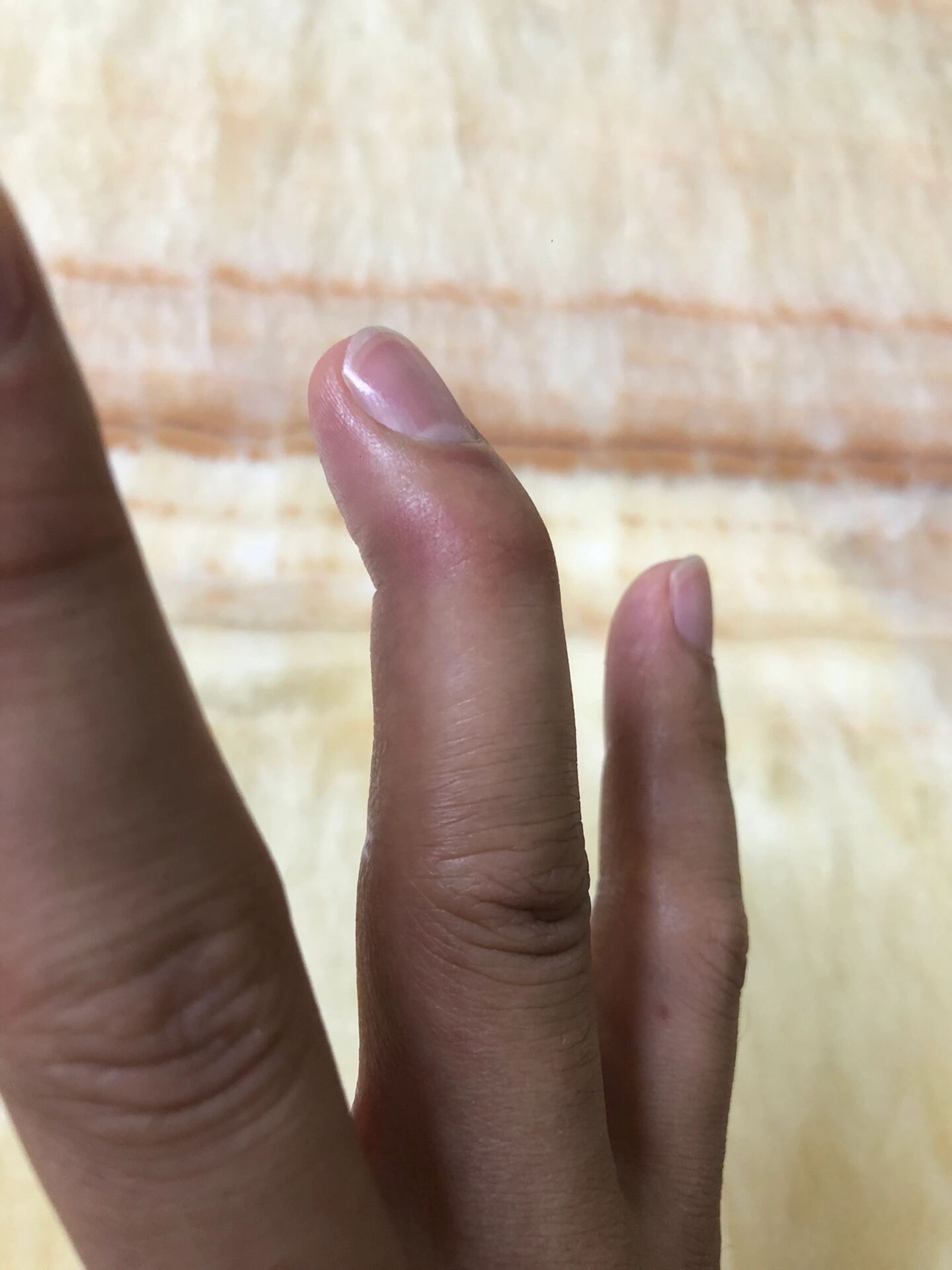 00 前几天打球戳到手指,当时不是很疼没太在意,第二天才发现手指