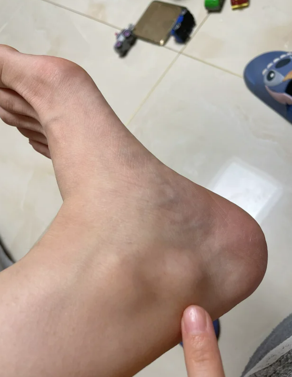 脚踝内侧鼓出个包还一按就疼,常见原因有踝关节扭伤和腱鞘囊肿