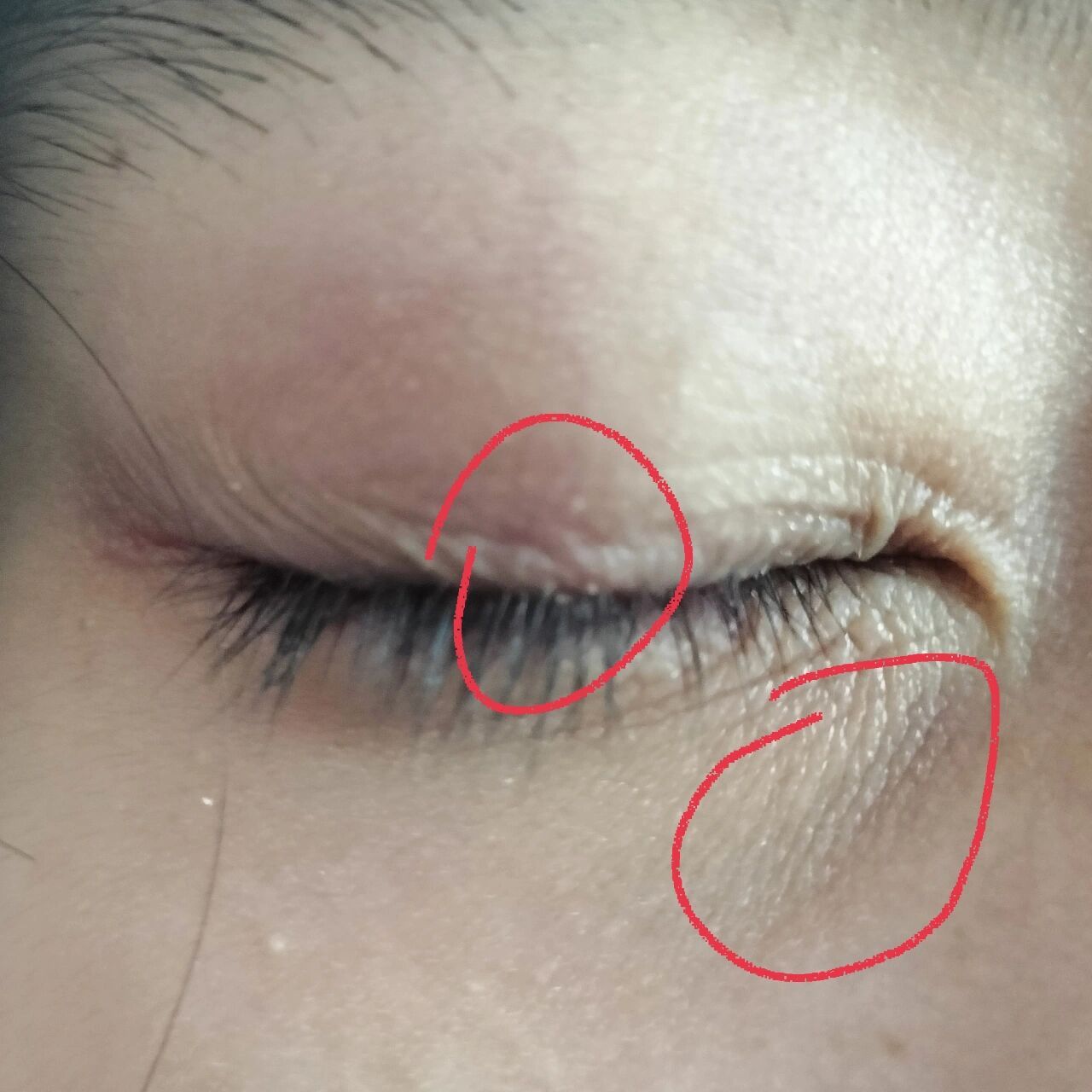 1 眼皮上老是有白色的干皮,长在睫毛根部,用手一弄睫毛也掉了.