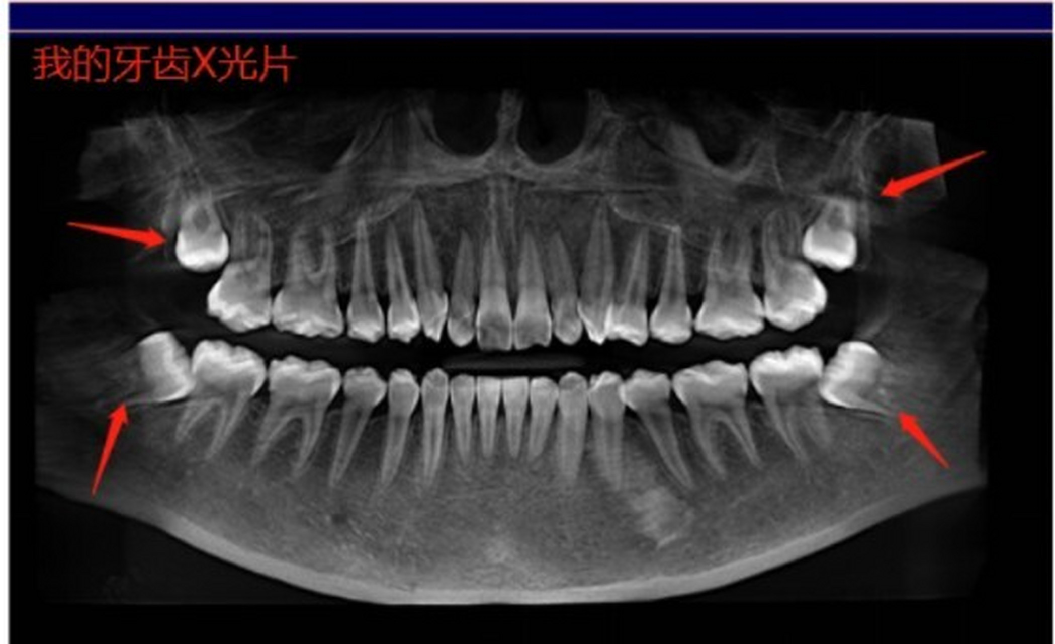 阻生智齿x光片图片