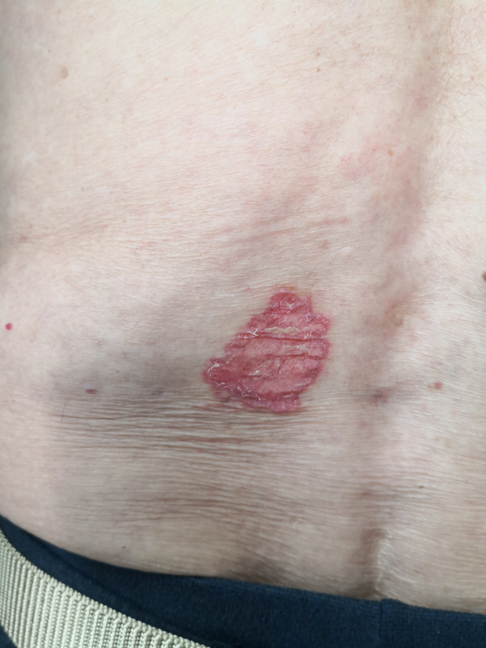 躯干部位大片红斑,边界清楚的红斑角化症状.汗孔角化症.