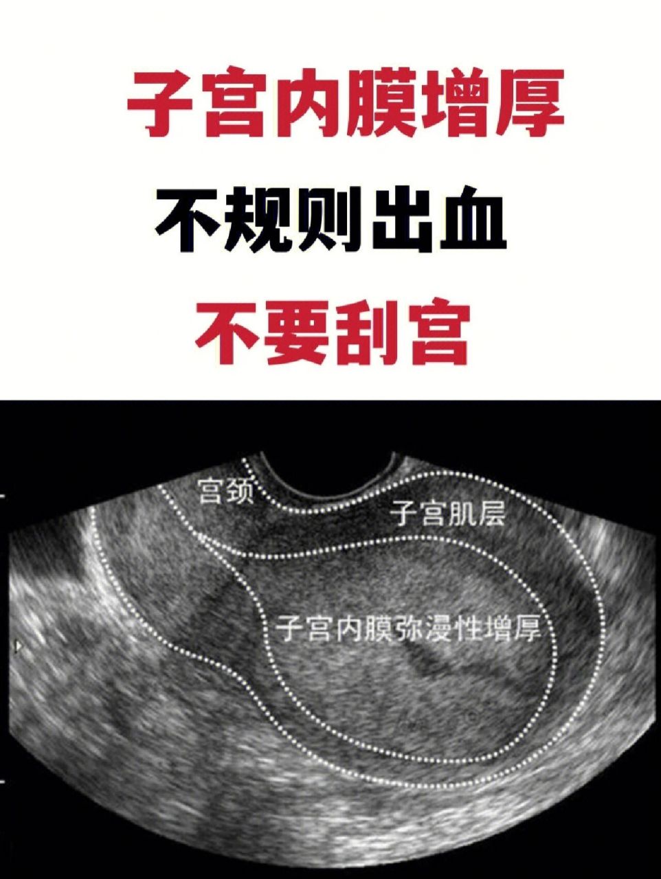 子宫内膜增厚,不需要刮宫 不规则出血,出血间隔长短不一,短者几日