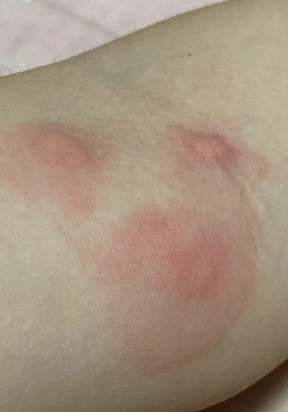 对海鲜或甲壳类过敏的人更容易