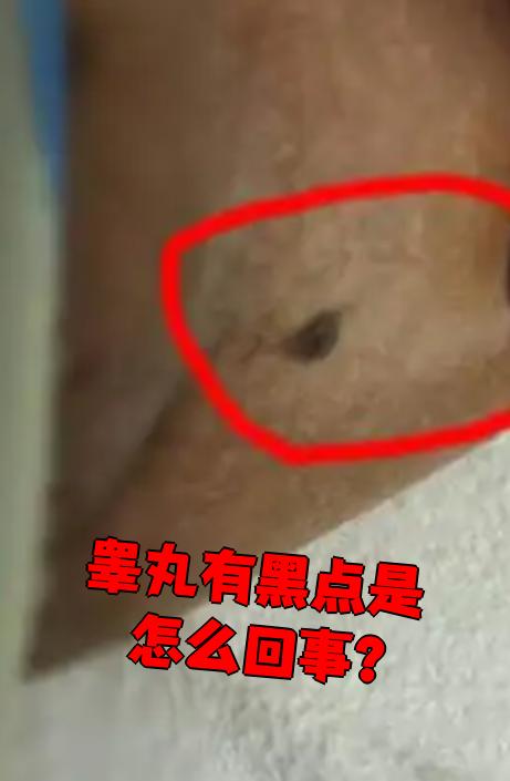 睾丸出现黑点可能和三种情况有关:淋巴结肿大,皮脂腺增生或黑色素