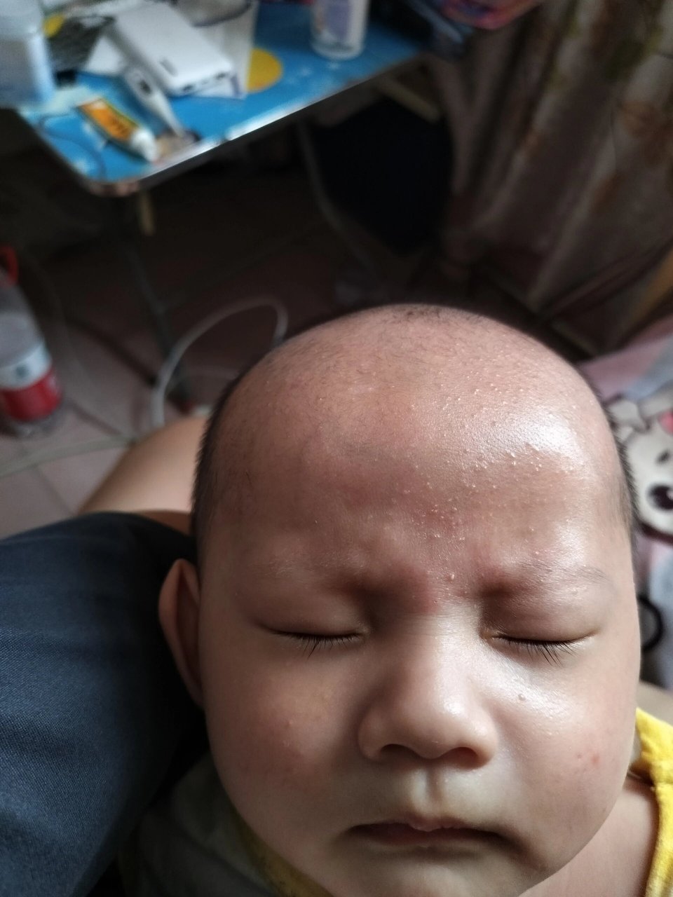 小家伙头上长了好多小疙瘩,各位看看是不是湿疹,真是愁死我了,唉
