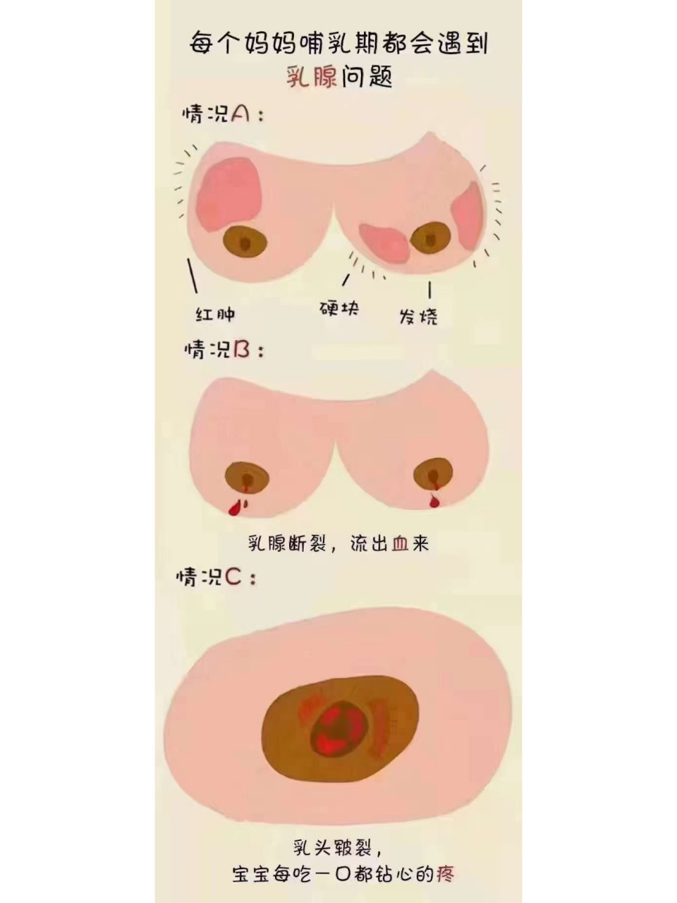 哺乳期乳腺管分布图图片